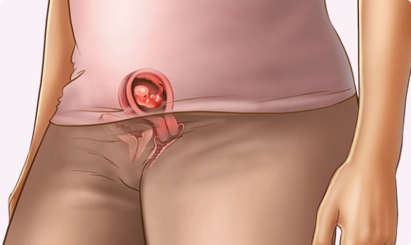 Paraproktit cronico è pericoloso