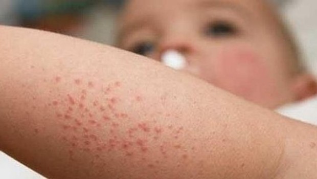 Come togliere il rossore da mani a eczema