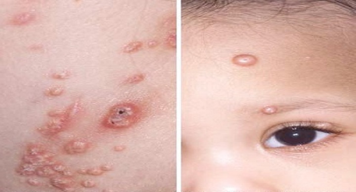 Eczema di disgidrotichesky sulle dita di trattamento di mani della casa