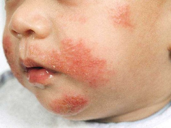 Dermatite e medicina di eczema