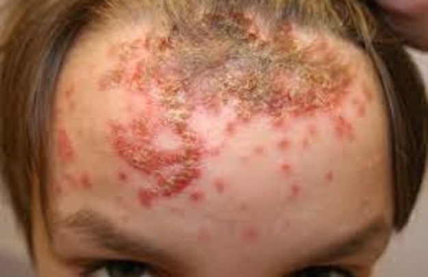 allarme virus spiagge italiane bufala