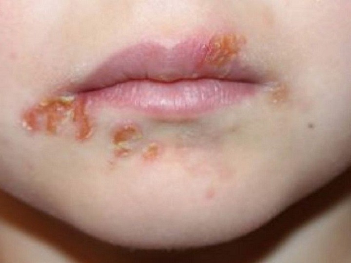 Impetigine Quelle Sconosciute Bollicine Rosse Sulla Pelle Dei Bambini Impetigine Quelle Sconosciute Bollicine Rosse Sulla Pelle Dei Bambini