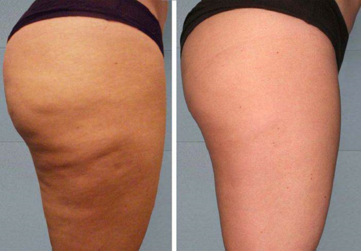 trattamento cellulite urto