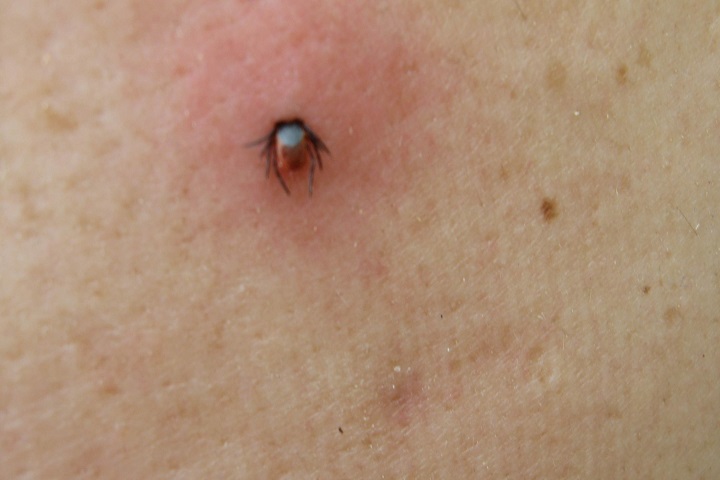 A Piedi Nudi Sul Prato Occhio Alle Punture Di Zecca Un Rischio Che Aumenta In Estate Cosa Fare Se Morde Un Bambino